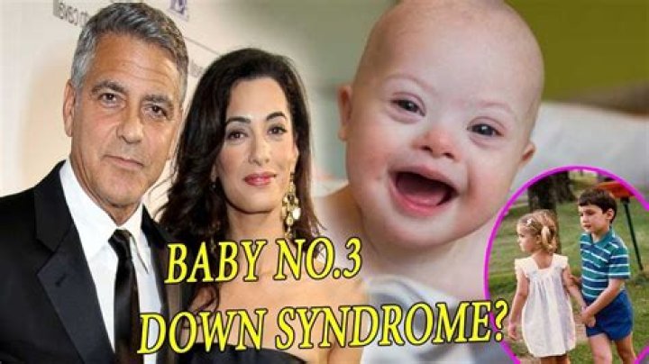George Clooney's Twins And Down Syndrome