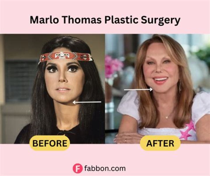 Marlo Thomas's Plastic Surgery Journey Revealed