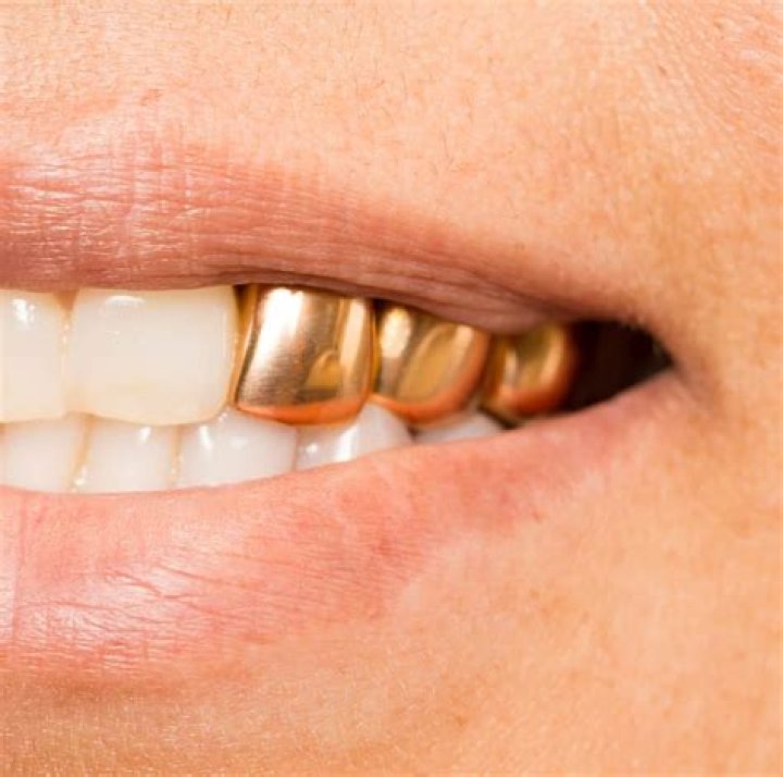 Unlock The Secrets Of Permanent Gold Teeth: Discoveries And Insights